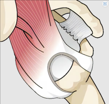 肩腱板断裂イメージ